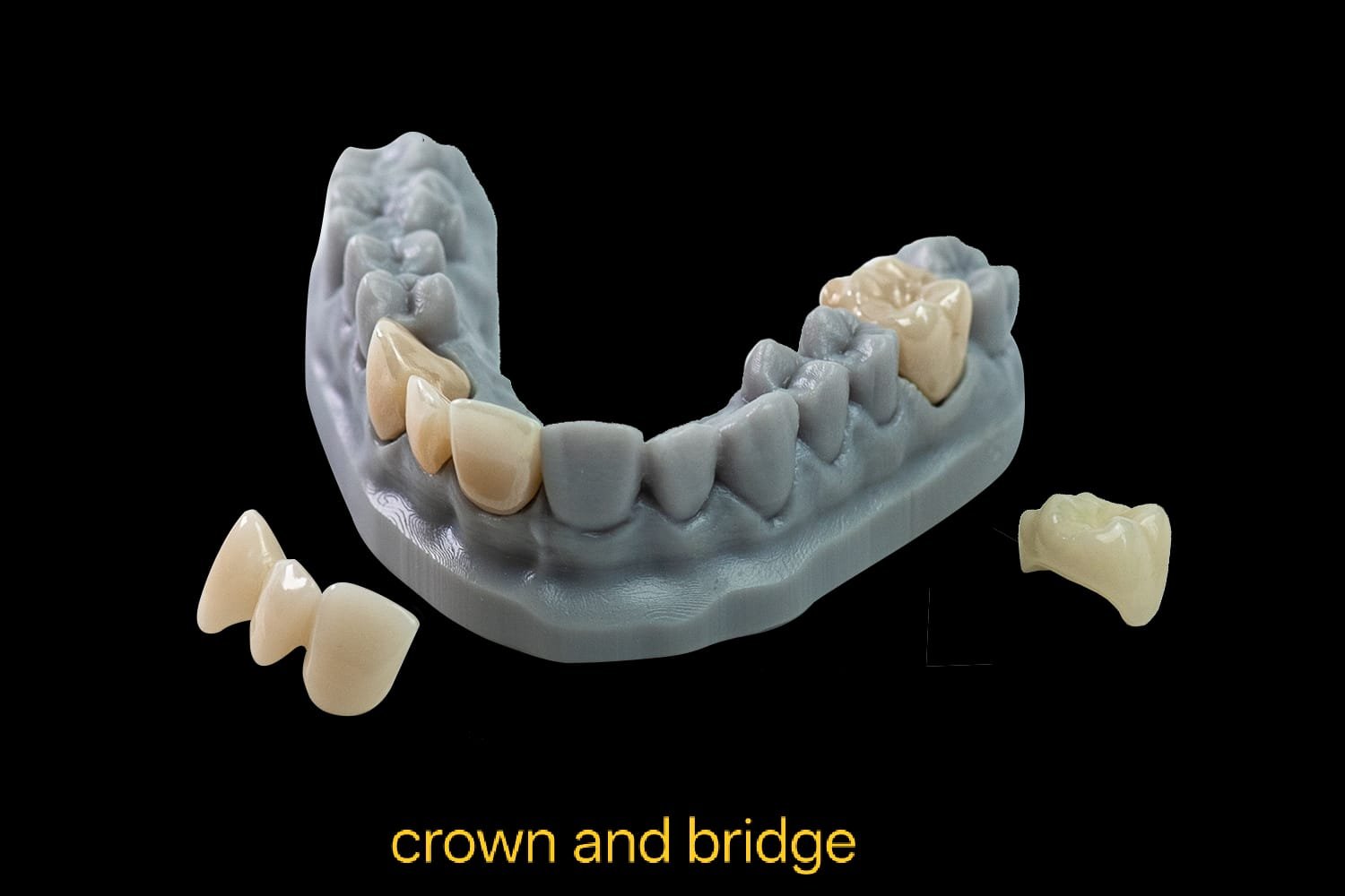 Crown and Bridges