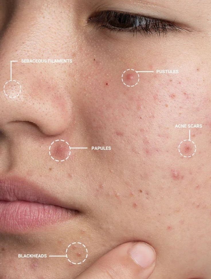 Personalized Treatment for Acne-Prone Skin