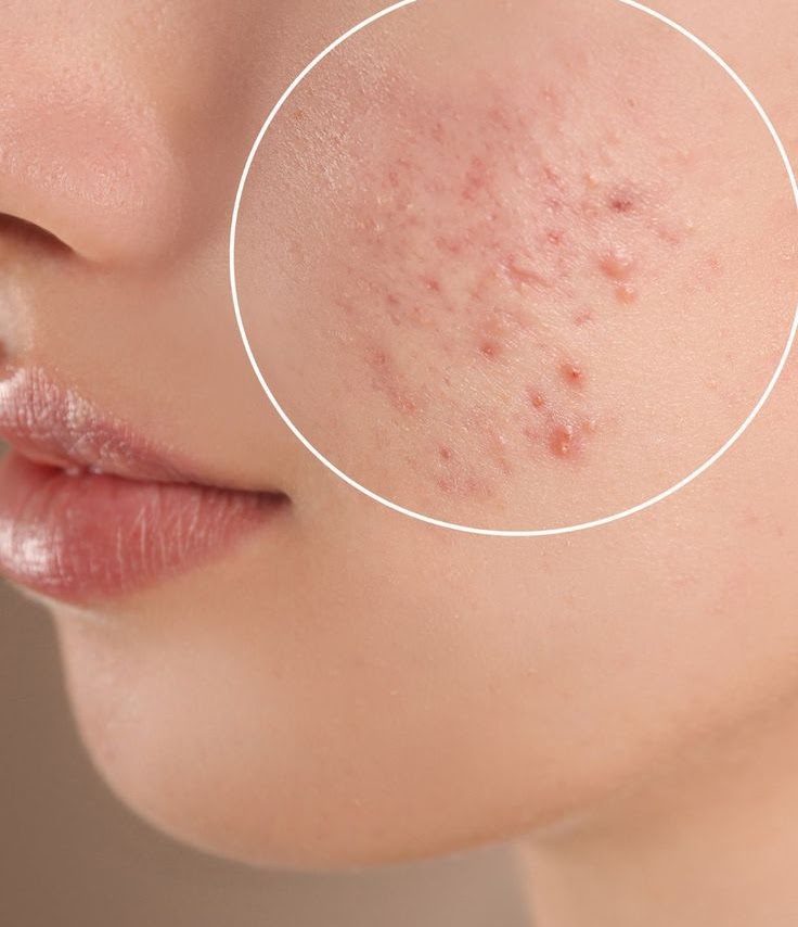 What is Acne?