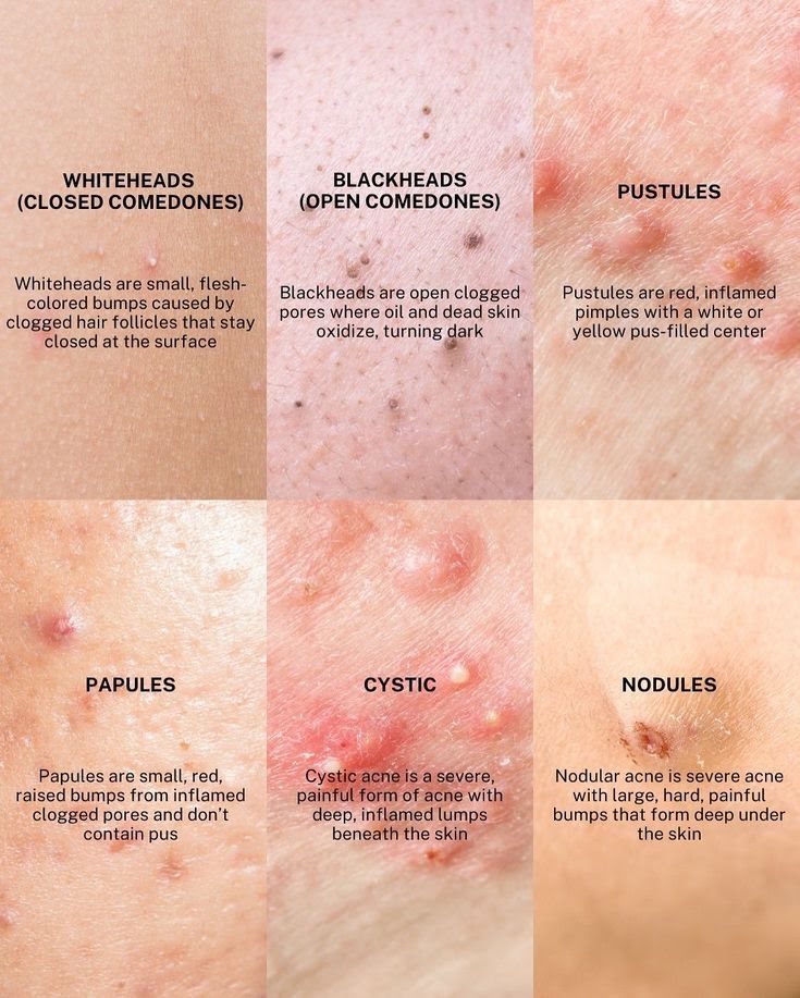 Common Signs of Acne