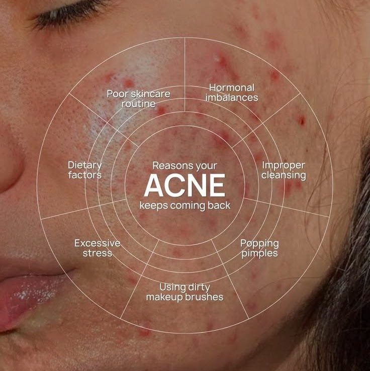 What Causes Acne?