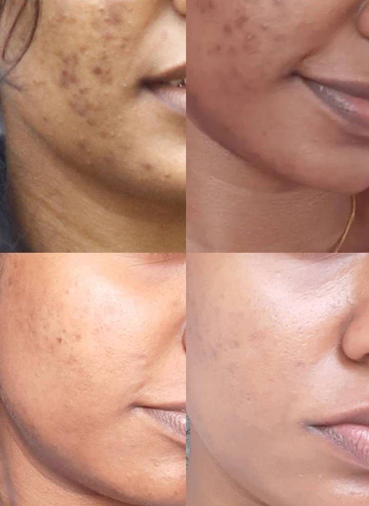 Benefits of Acne Treatment