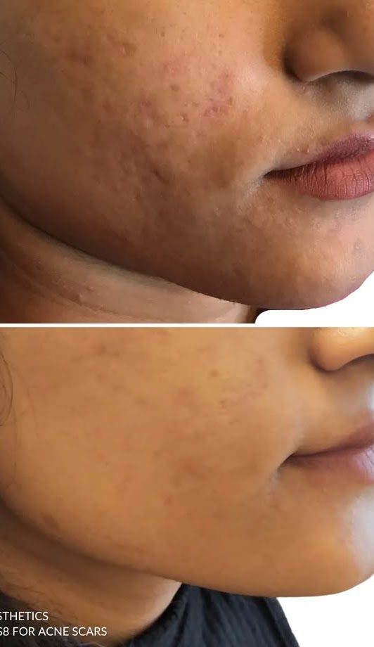 Benefits of Pigmentation Treatment