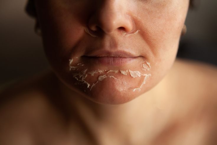 Chemical Peels