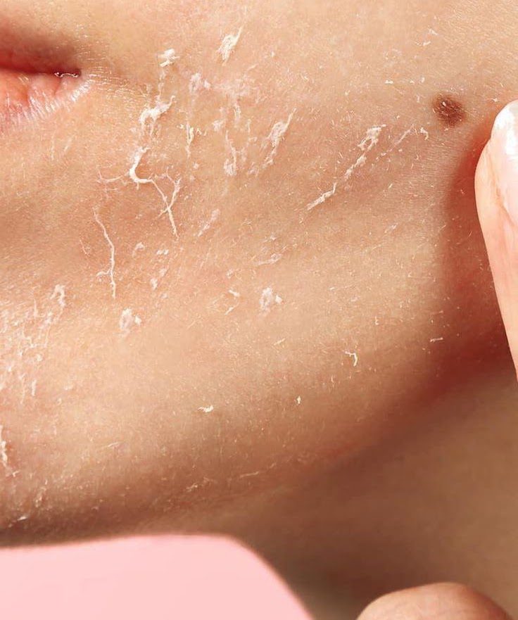 Advanced Skin Rejuvenation for Acne, Pigmentation, Melasma and Skin Texture Concerns