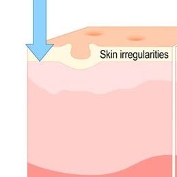 How Does a Chemical Peel Work?