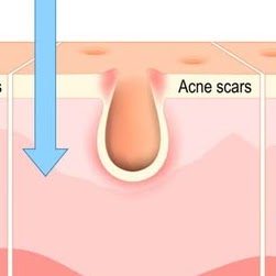 Types of Chemical Peels