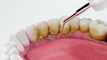 What is Dental Scaling?