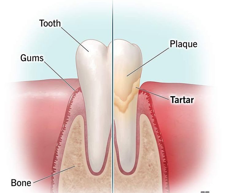 Why is Professional Teeth Cleaning Important?