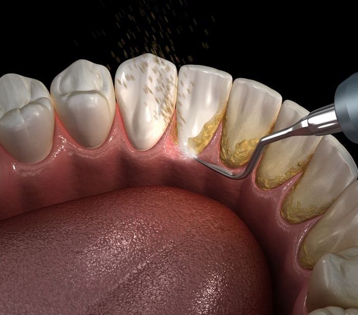 What Happens During Teeth Cleaning?