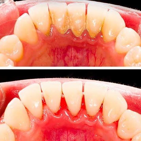BEFORE AND AFTER