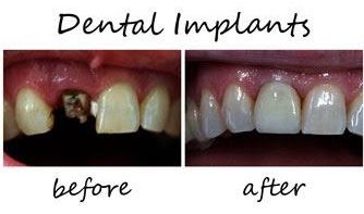 Long-Term Solution for Missing Teeth