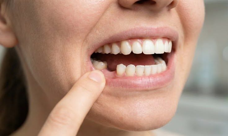 Are Dental Implants Painful?