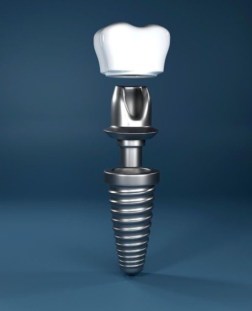 What Are Dental Implants?