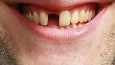Who May Need Dental Implants?