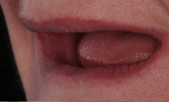 How Long Do Dental Implants Last?