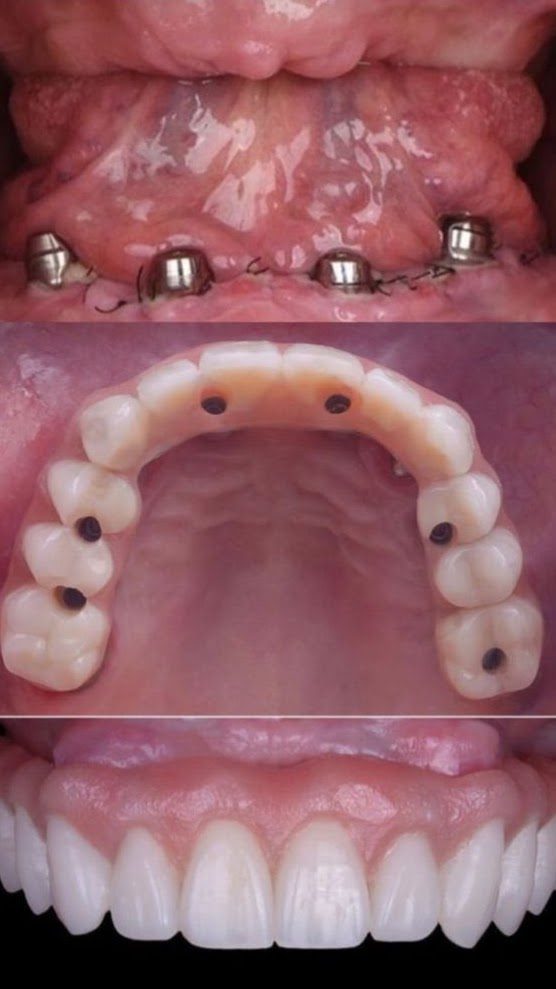 Benefits of Dental Implants