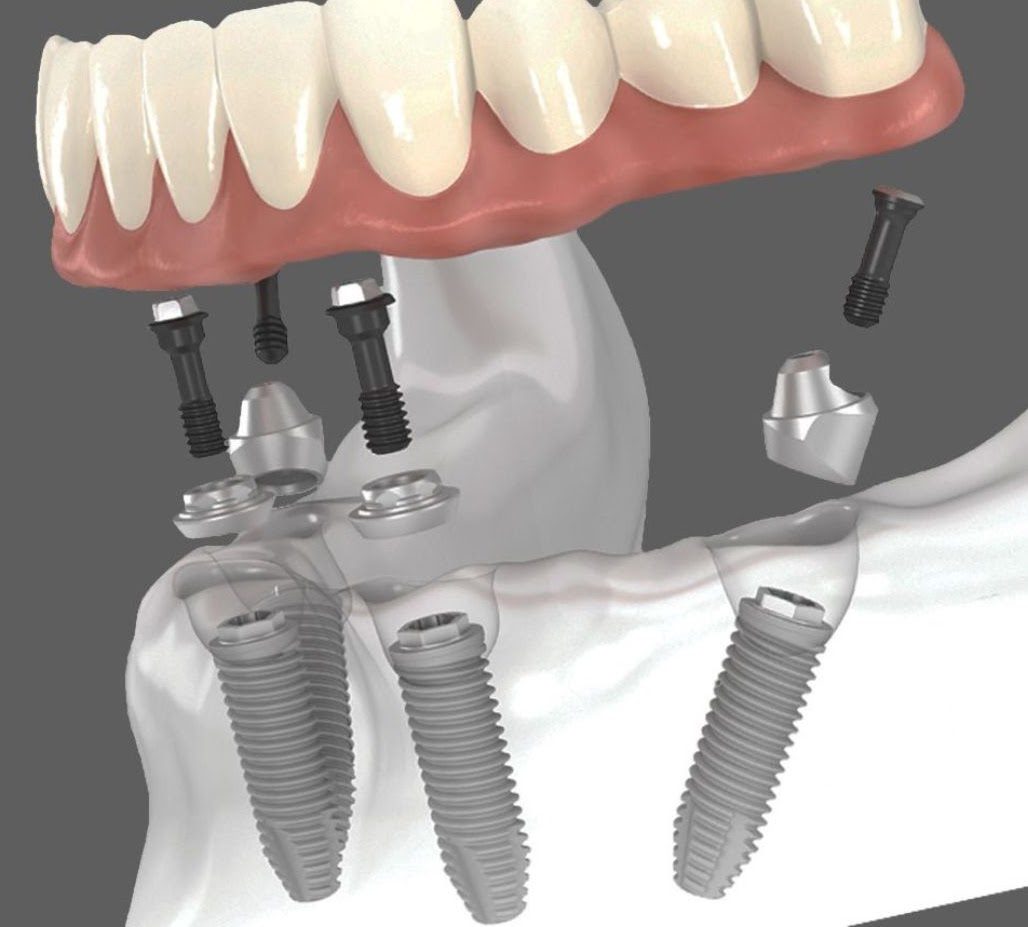Dental Implant Treatment Process