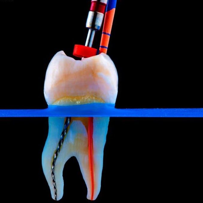 3. Cleaning of Root Canals