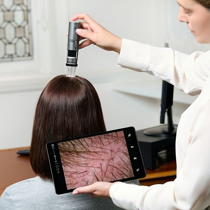 Male Pattern Hair Loss Management