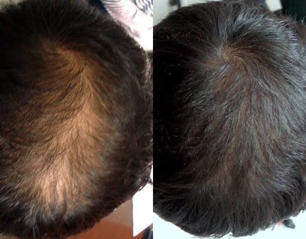 Benefits of PRP Hair Treatment