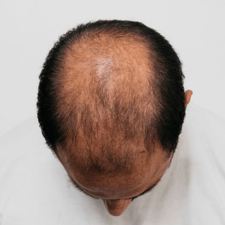 Male Pattern Hair Loss