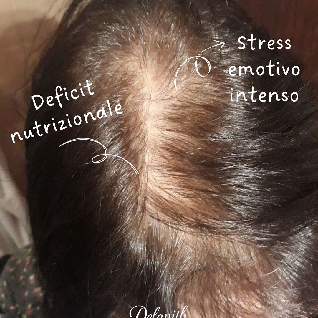 Female Pattern Hair Loss