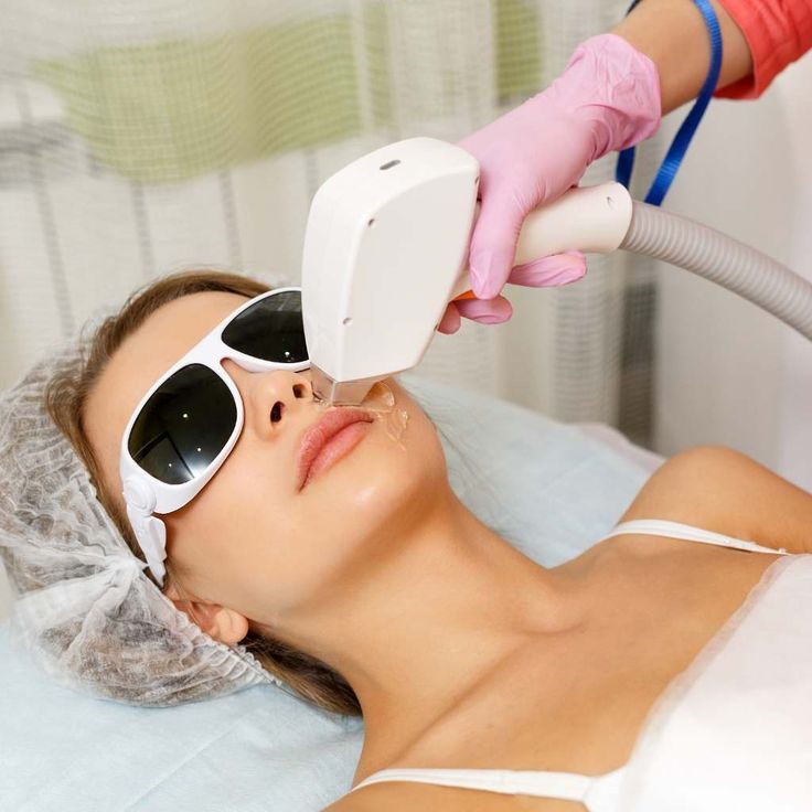 Acne Scar Laser Treatment