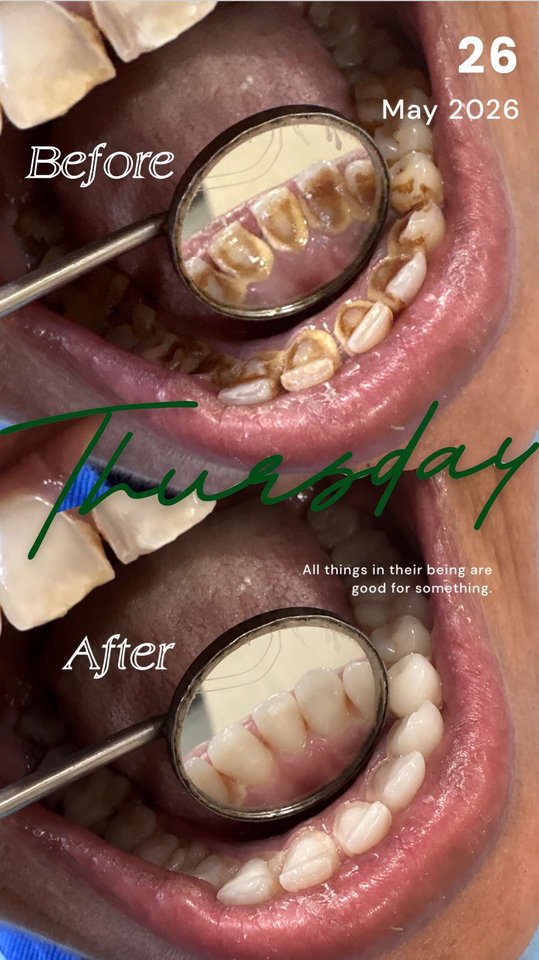 Professional Teeth Cleaning & Polishing