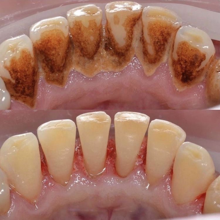 Professional Teeth Cleaning & Polishing