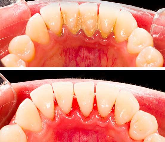 Professional Teeth Cleaning & Polishing