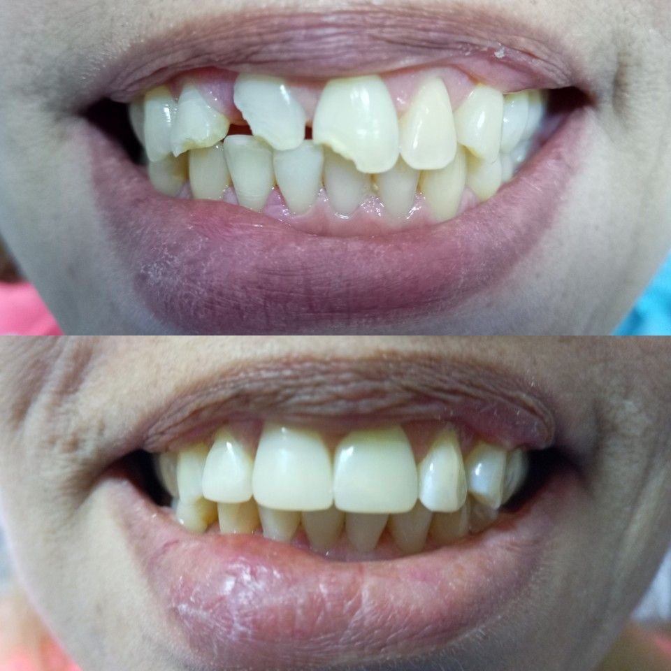 Anterior tooth build up