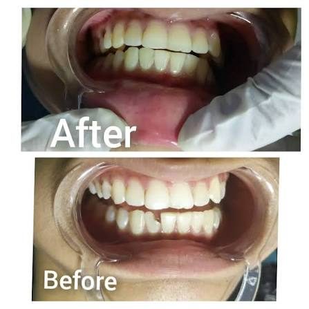 Anterior tooth build up