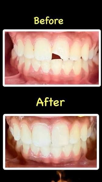 Anterior tooth build up