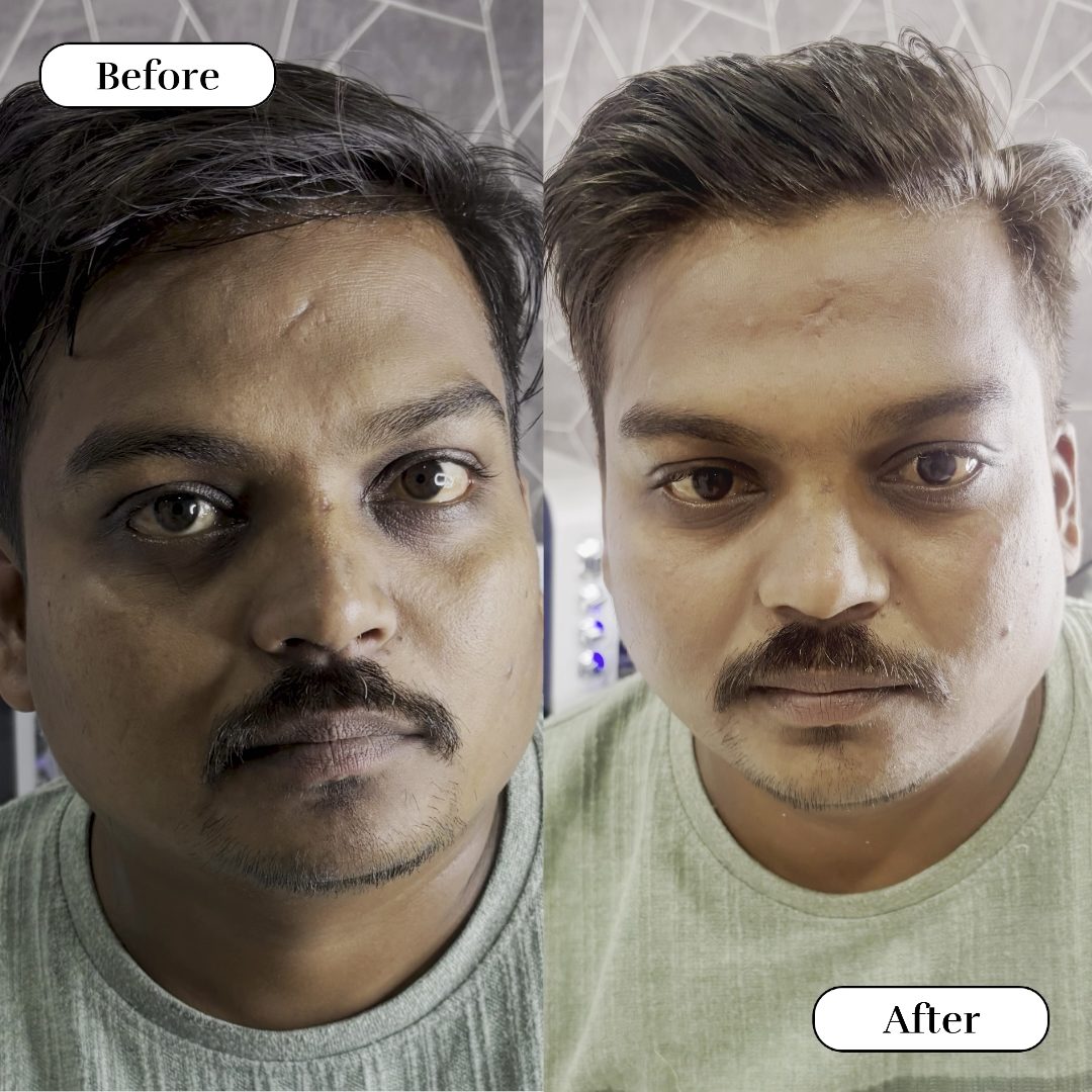 OXYGENEO FACIAL