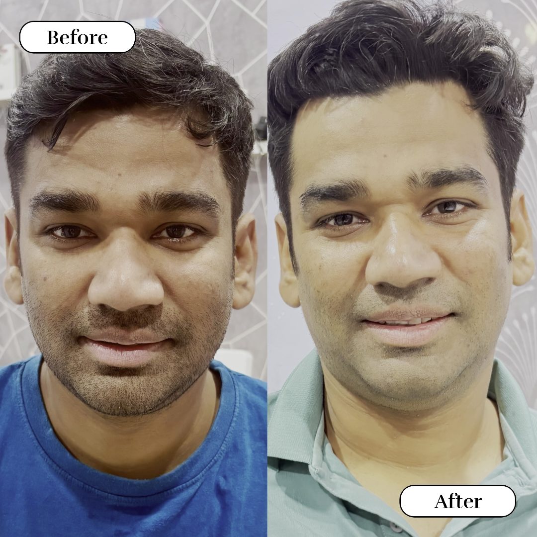 CHEMICAL PEEL