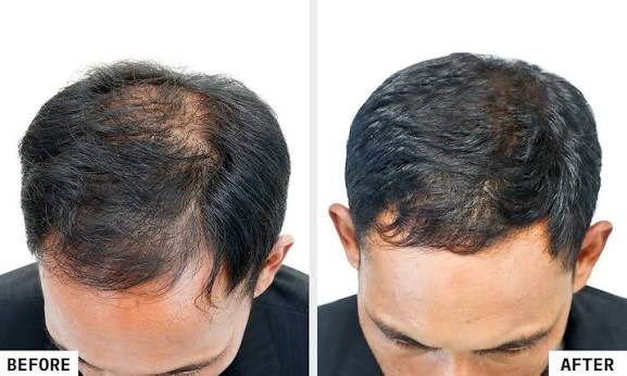 PRP Therapy