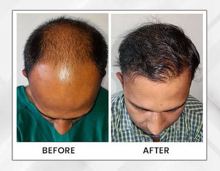 PRP Therapy