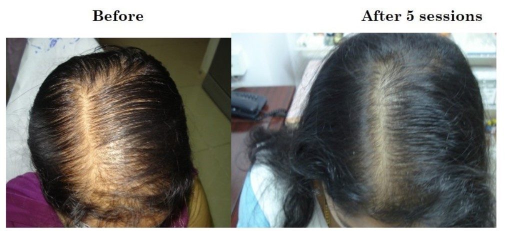 PRP Therapy