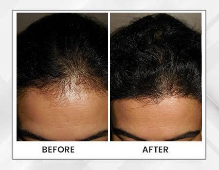 Hair Fall Management