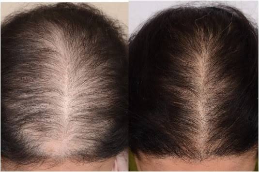 Hair Fall Management