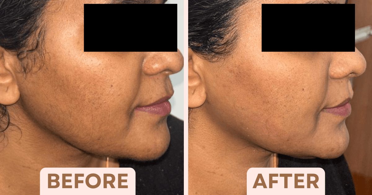 Laser hair reduction