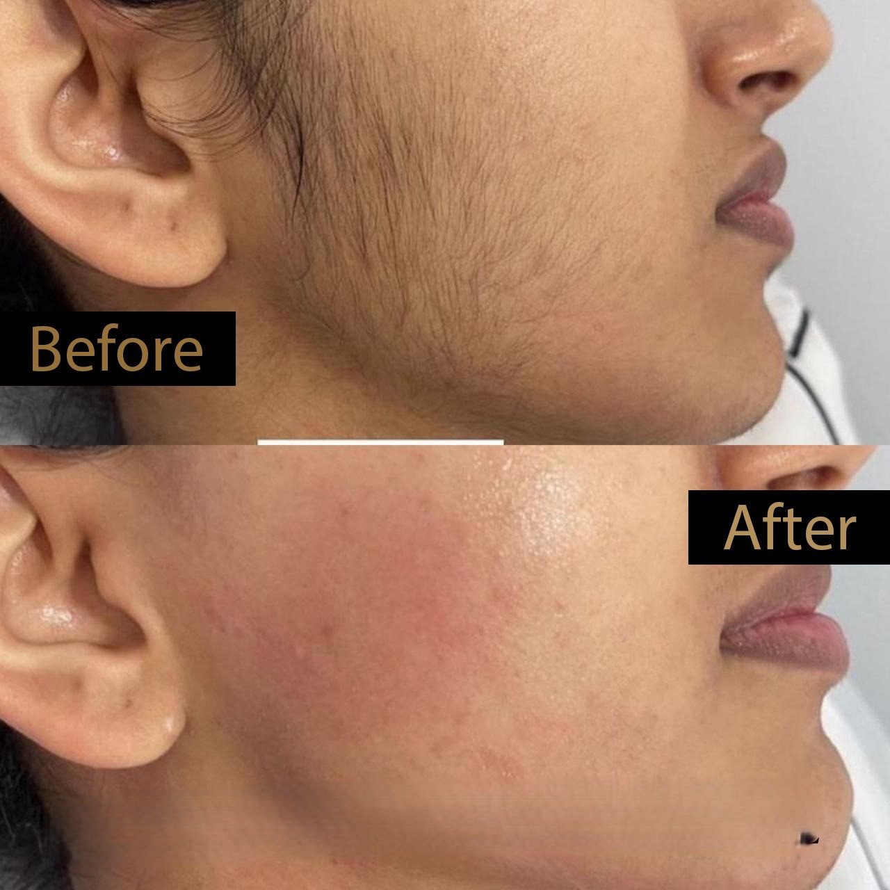 Laser hair reduction