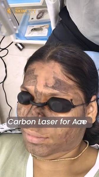Carbon Laser Peel