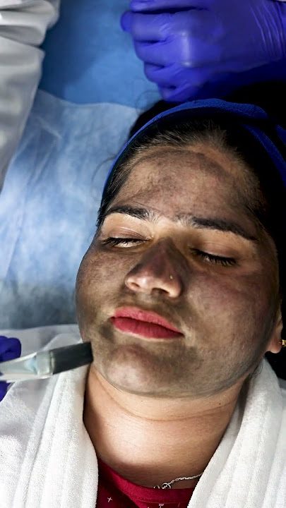 Carbon Laser Peel