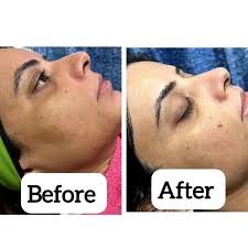 Carbon Laser Peel