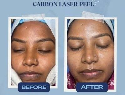 Carbon Laser Peel