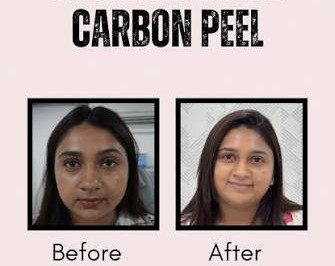 Carbon Laser Peel