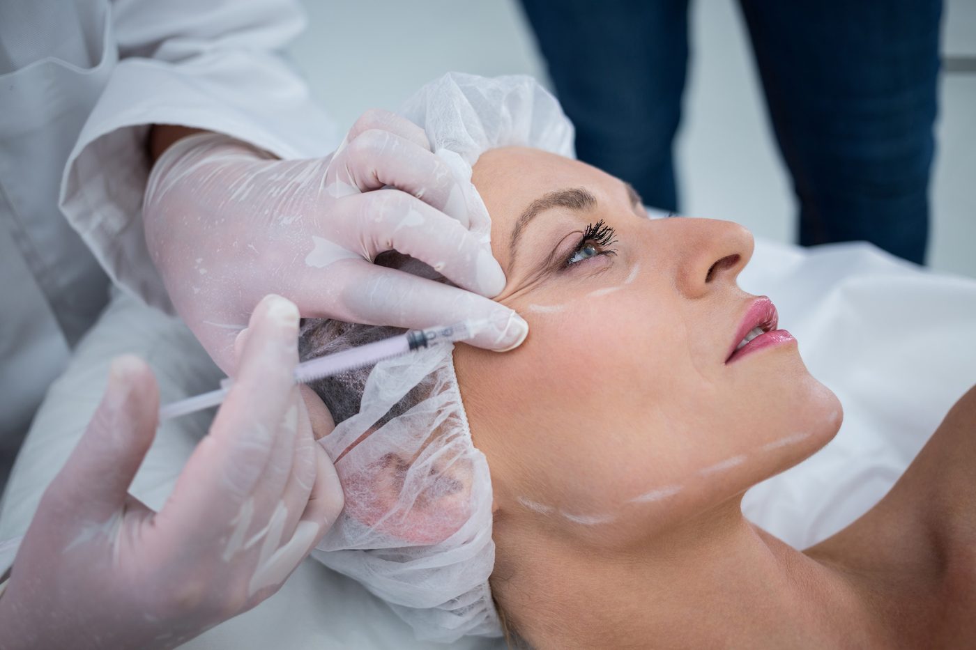 Acne Scar Management