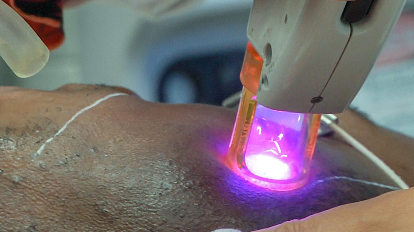 Skin Rejuvenation Laser Treatments